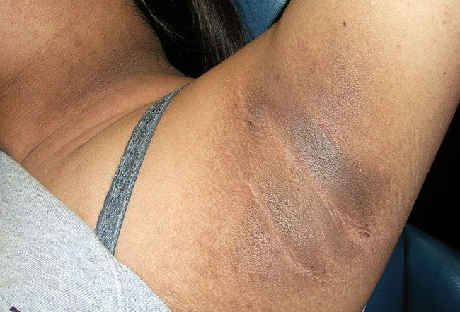 Acanthosis Nigricans Treatment