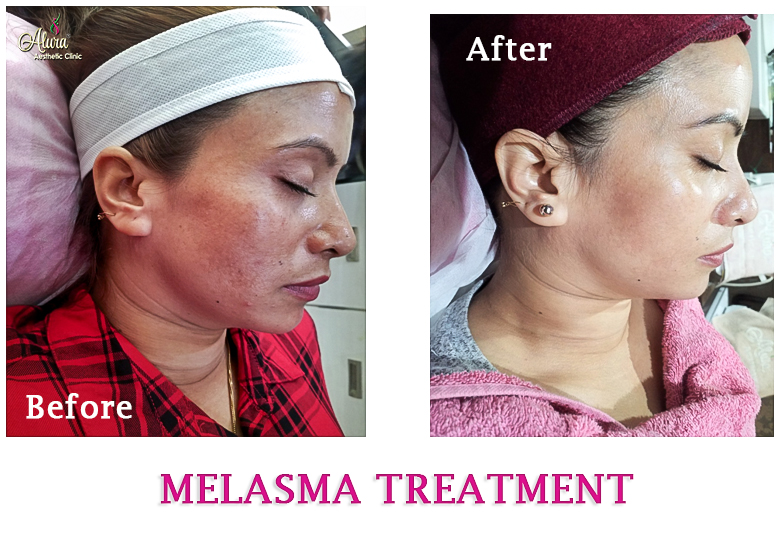 Melasma Treatment