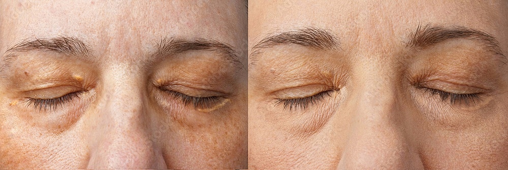 Xanthelasma Treatment