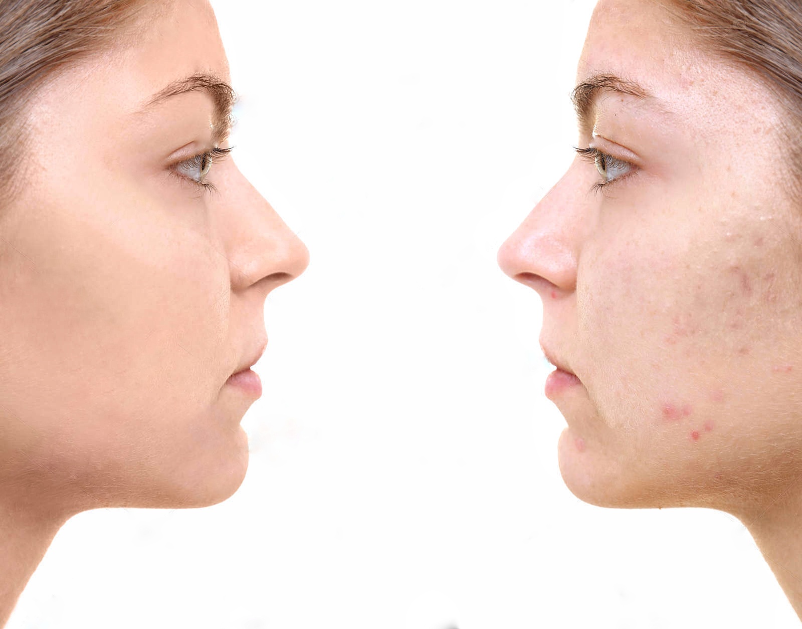 Acne Scars Treatment