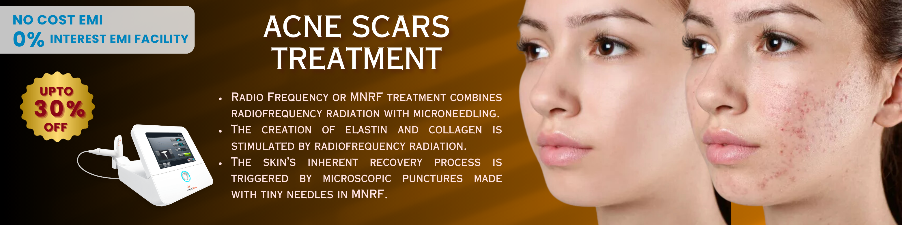 acne scar treatment