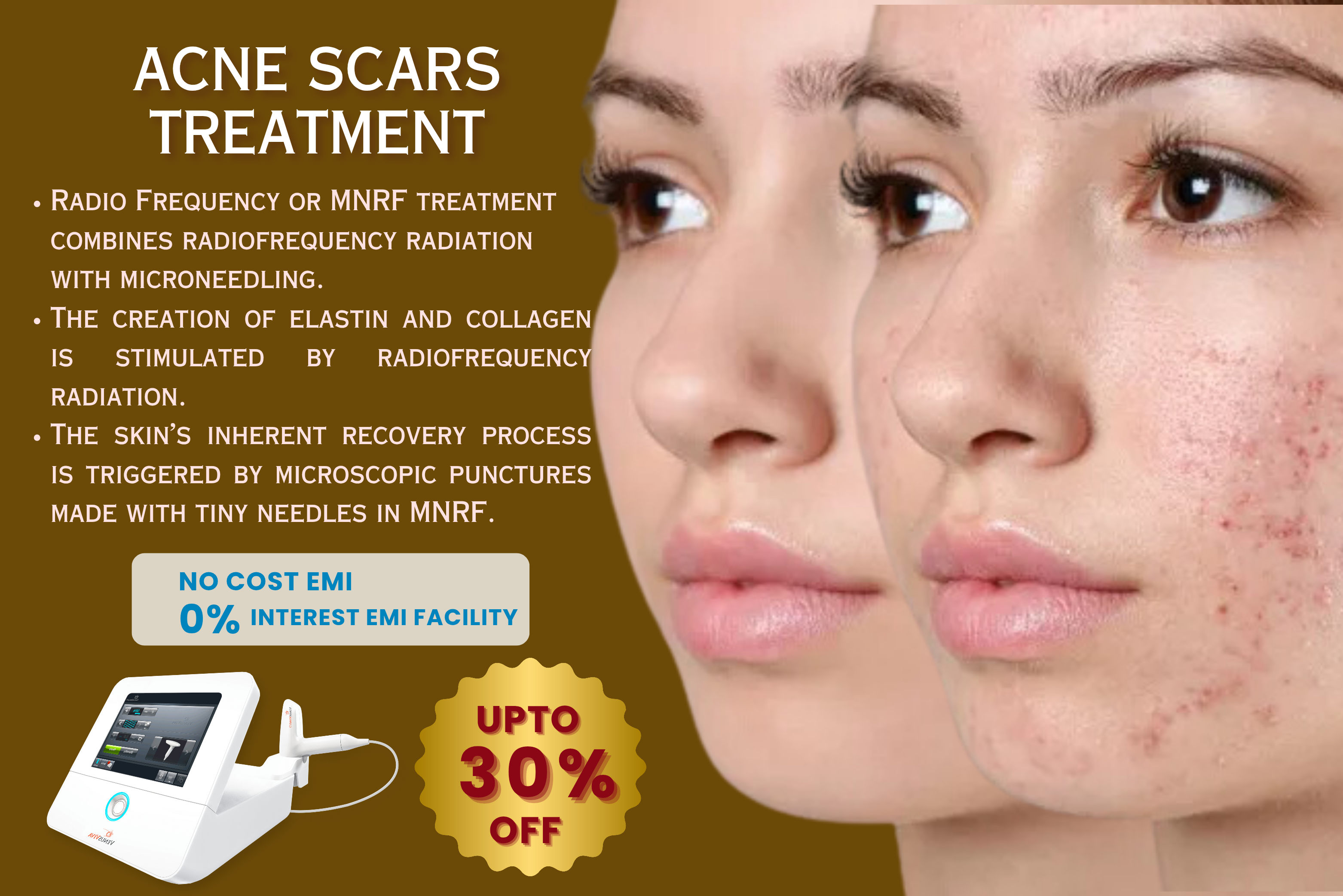 acne scar