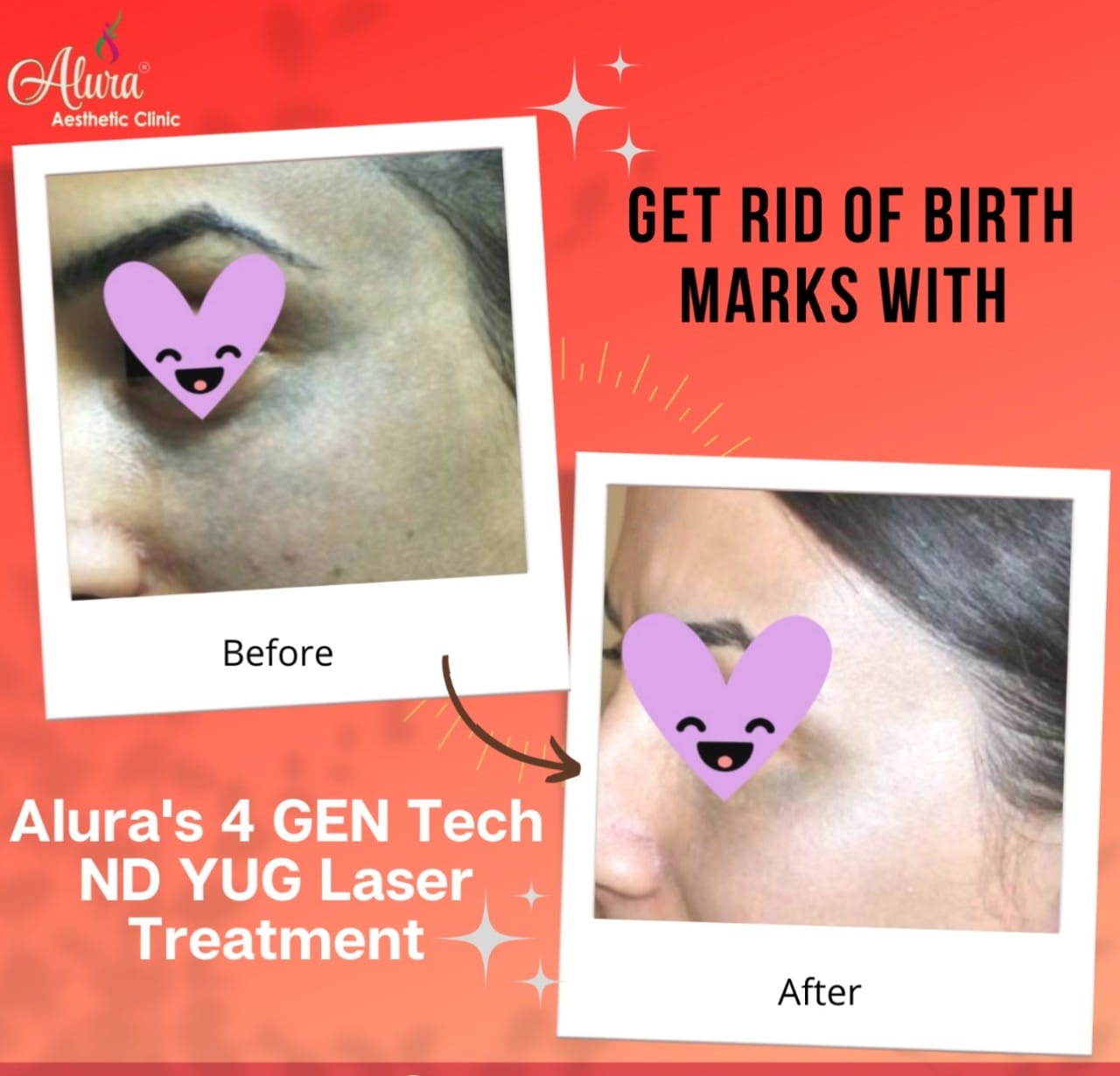 Birth Mark Removal