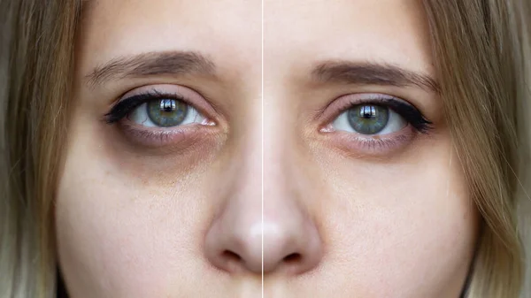 Under Eye Dark Circles Removal