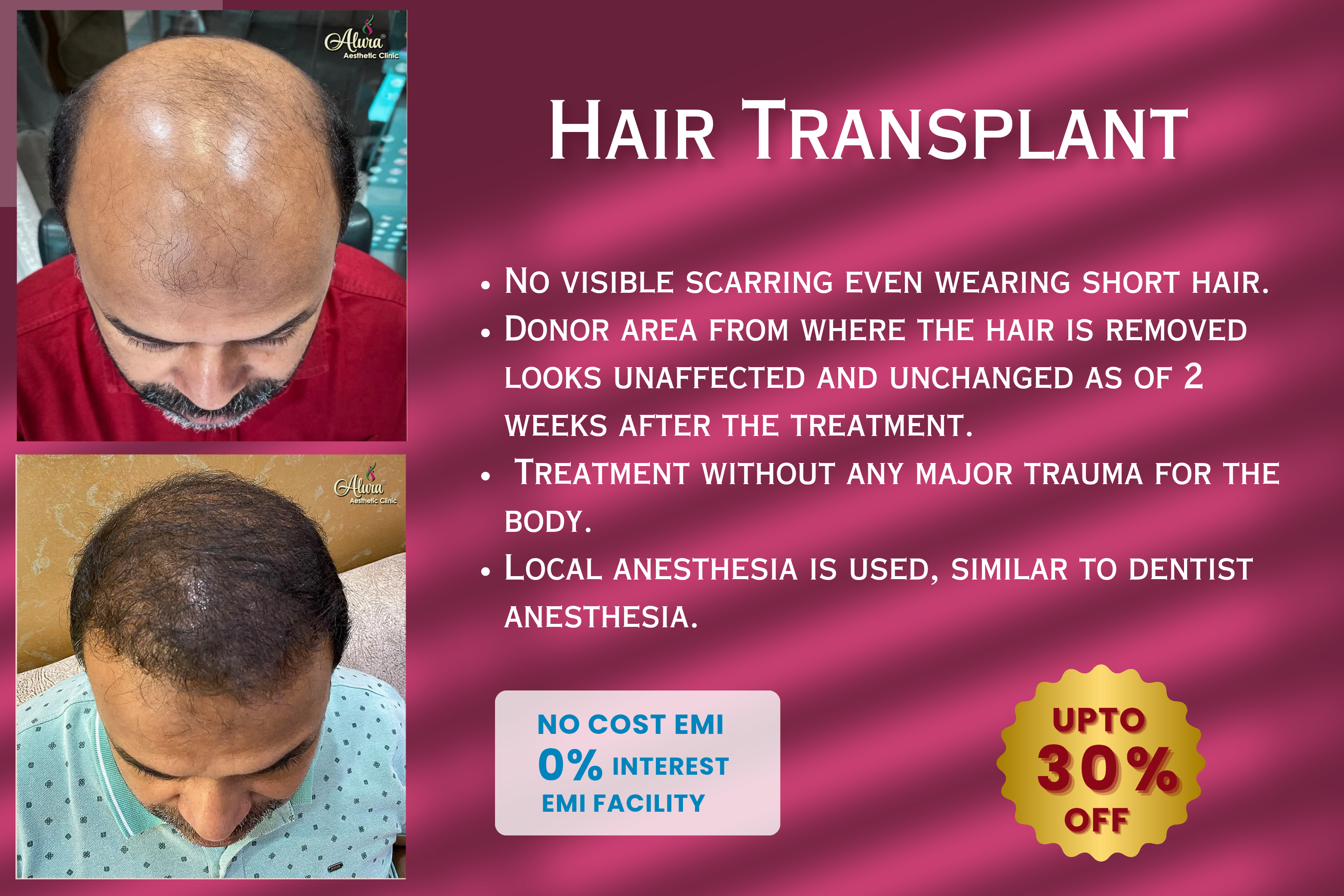 hair Transplant (2)