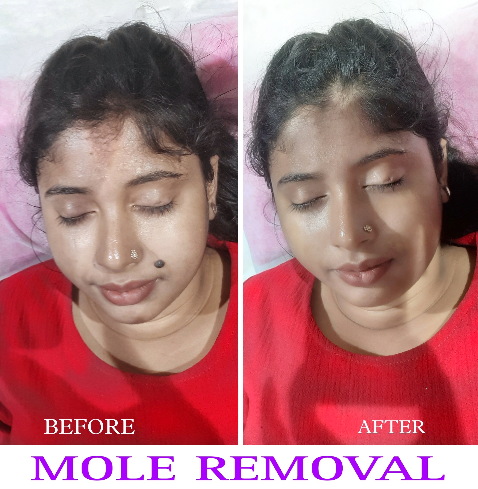 Mole/Wart Removal