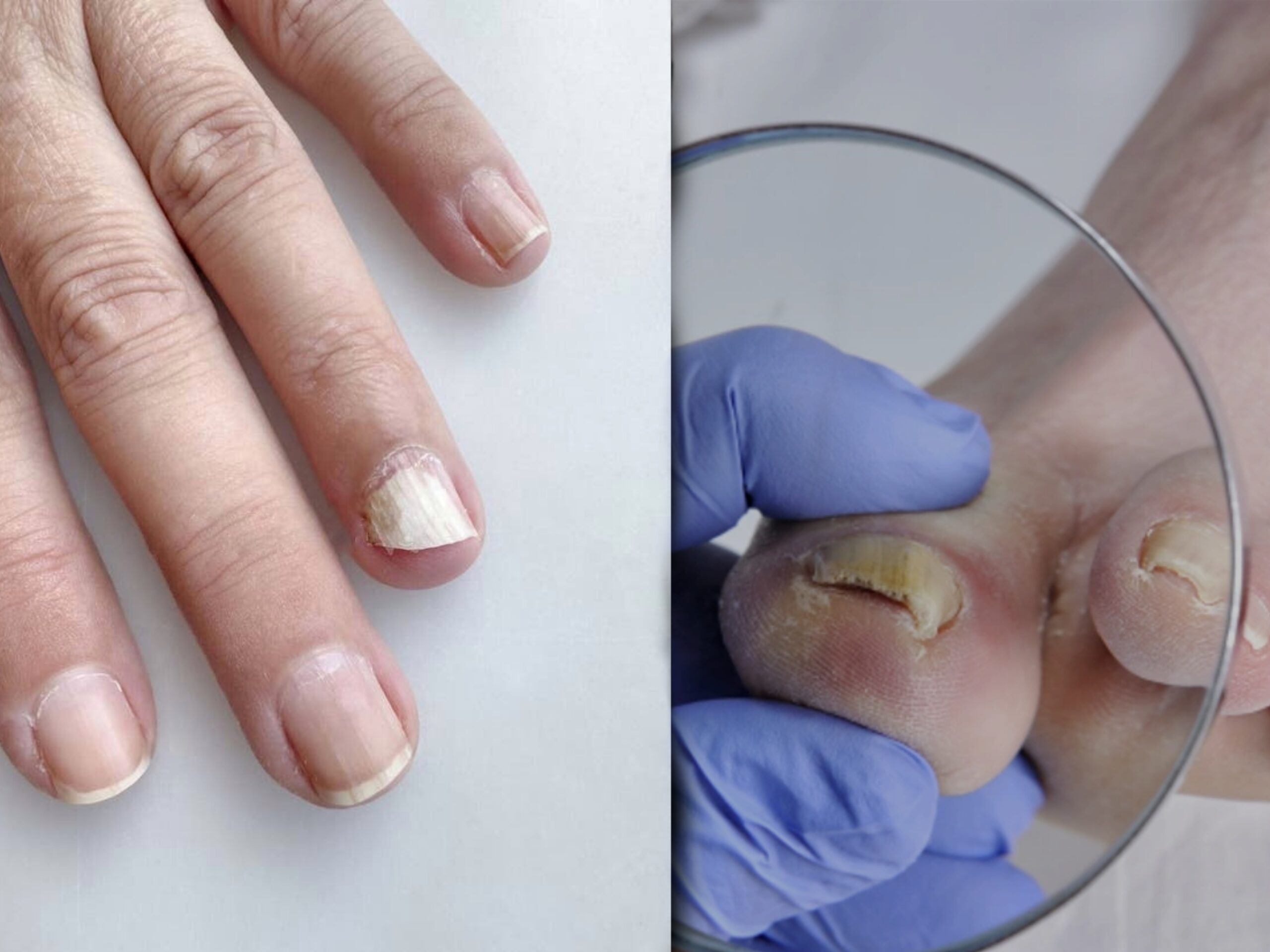 Nail Fungus Treatment