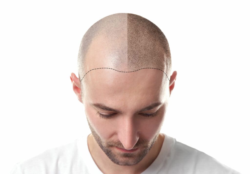 Micropigmentation for Scalp