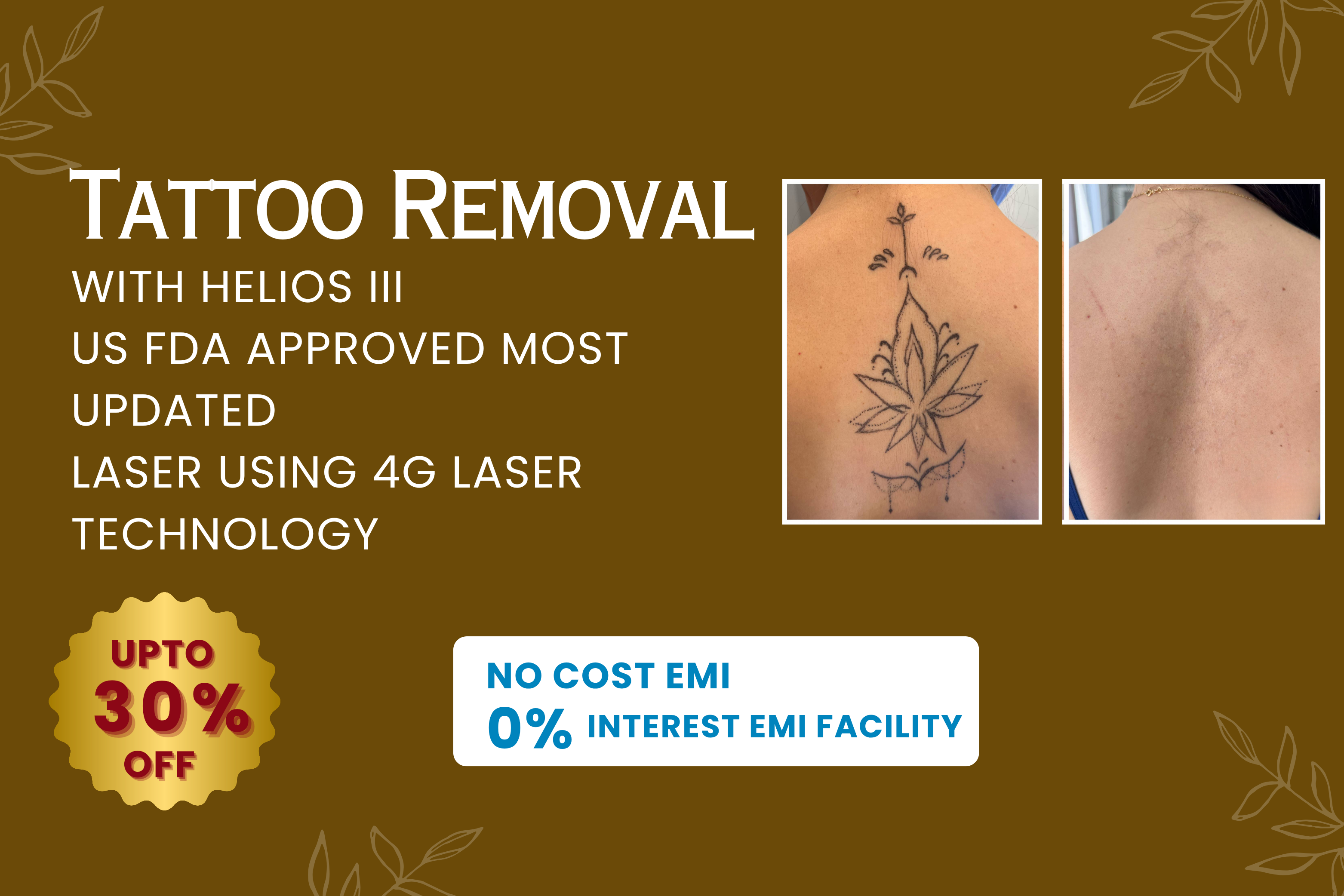 tattoo removal (3)